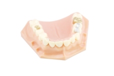 牙科模型（不同的处理）